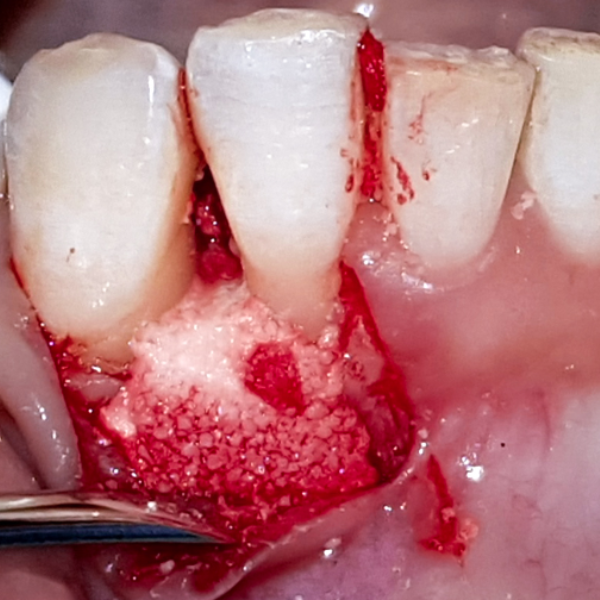TWO_WALL_PERIODONTAL_BONE_DEFECT