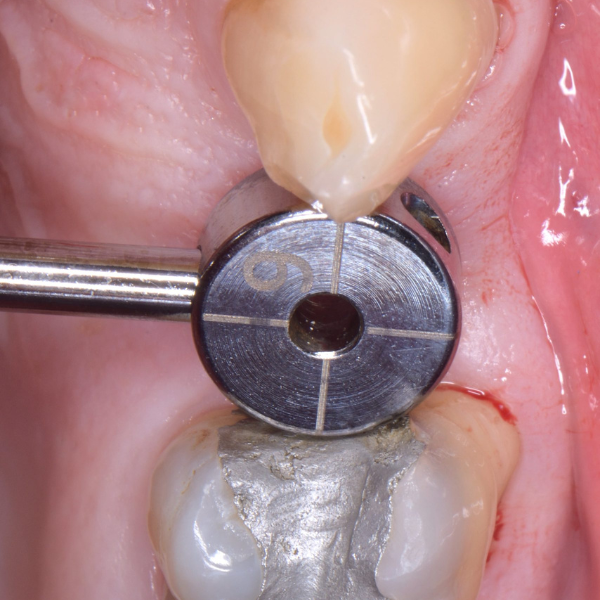 UL5_EXTRACTION_AND_IMPLANT_PLACEMENT