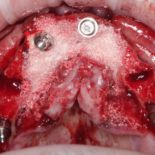 UPPER_AND_LOWER_ARCH_IMMEDIATE_LOAD_WITH_IMPACTED_CANINE_REMOVAL_v2
