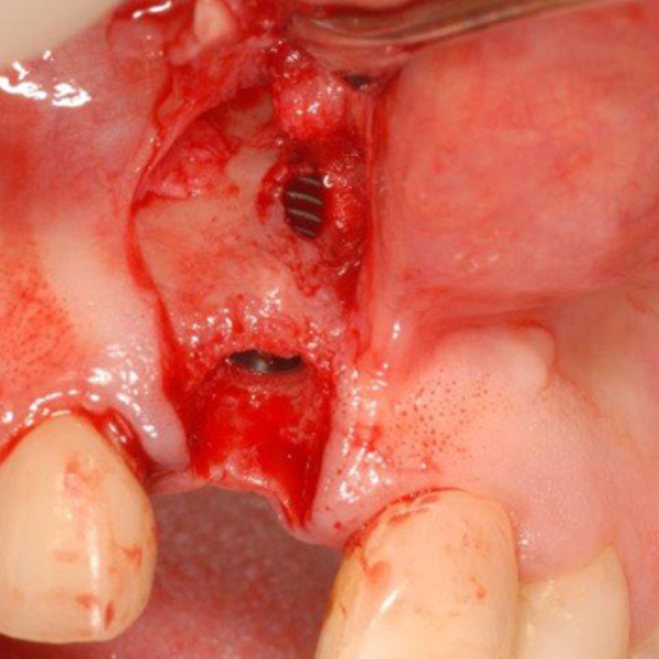 UPPER_ANTERIOR_IMPLANT_PLACEMENT