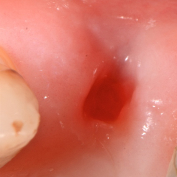UPPER_PRE-MOLAR_2_