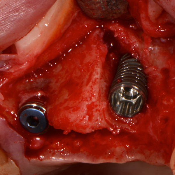 UPPER_PRE-MOLAR_BRIDGE