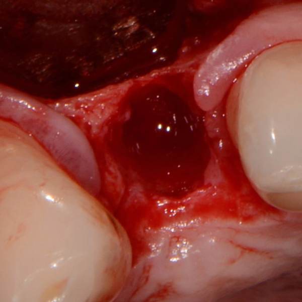 UPPER_RIGHT_LATERAL_INCISOR