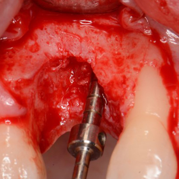 UPPER_RIGHT_PREMOLAR