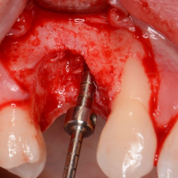 VERTICAL_REGENERATION_OF_BOTH_BUCCAL_AND_PALATAL_BONE_WALLS