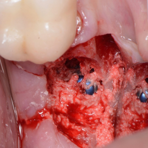 _PUSH-IN_IMPLANT_TECHNIQUE